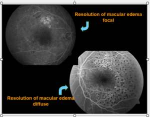 Diabetic Retinopathy Laser Treatment