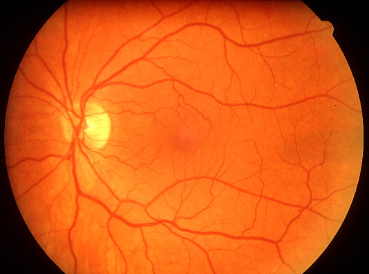 No Diabetic Retinopathy