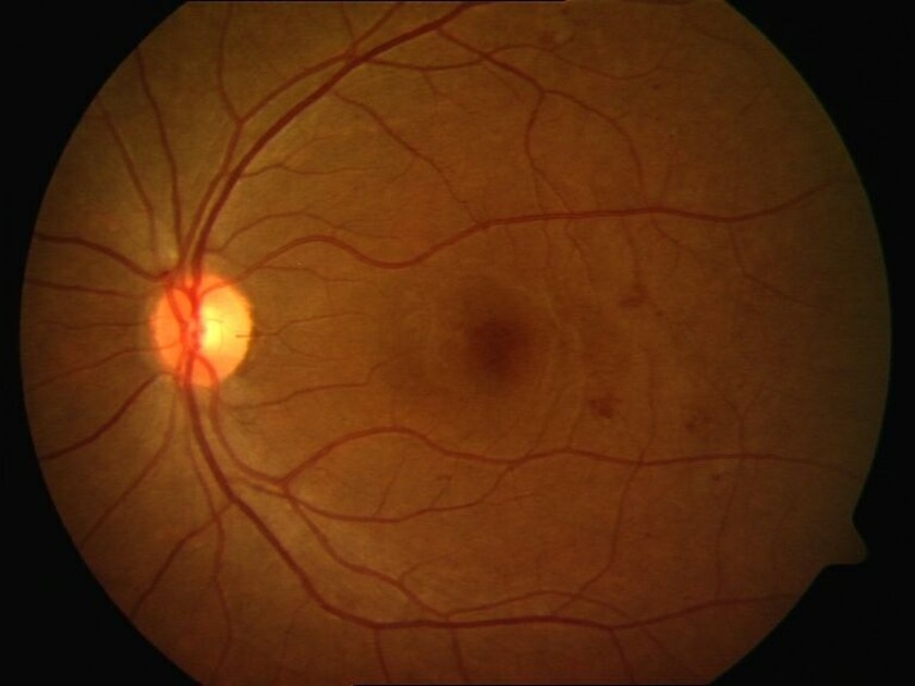 Mild Non-Proliferative Diabetic Retinopathy