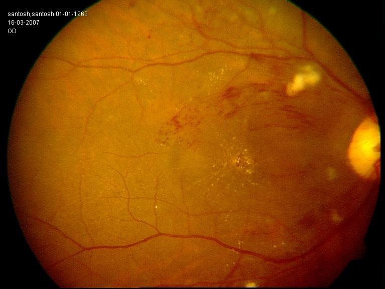 Moderate Non-Proliferative Diabetic Retinopathy