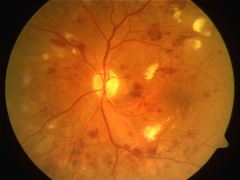 Severe Non-Proliferative Diabetic Retinopathy