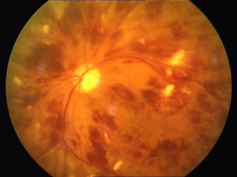 Very Severe Non-Proliferative Diabetic Retinopathy