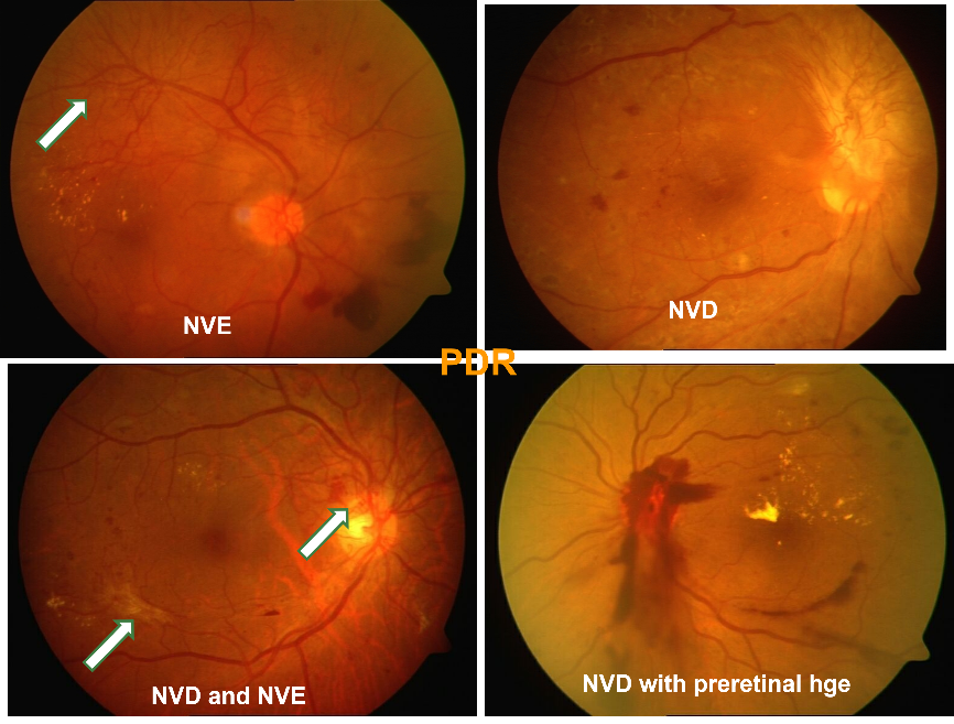Proliferative Diabetic Retinopathy